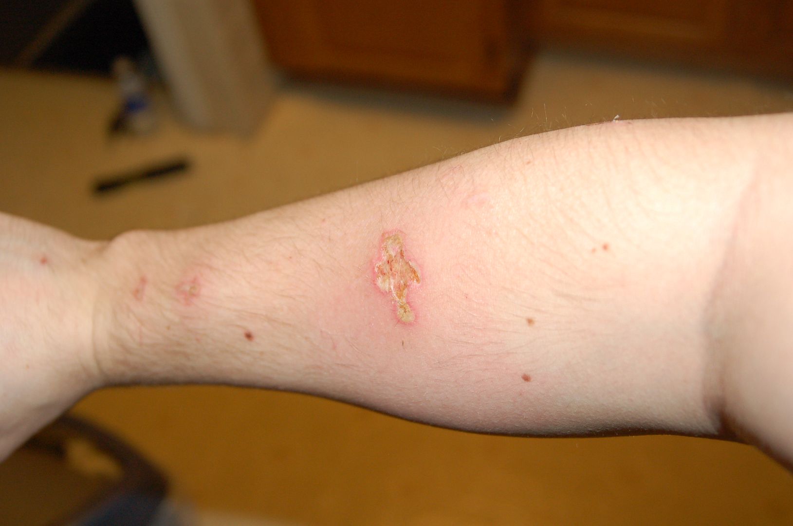 Arctic burn skin pic ? gone ? Laser Pointer Forums Discuss Laser Pointers High Power Lasers